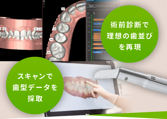 術前診断で理想の歯並びを再現 スキャンで歯型データを採取