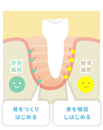 矯正治療による骨の動きの仕組み2