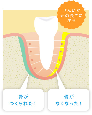 矯正治療による骨の動きの仕組み3